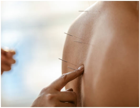 Bell Fountain Acupuncturist Ohio