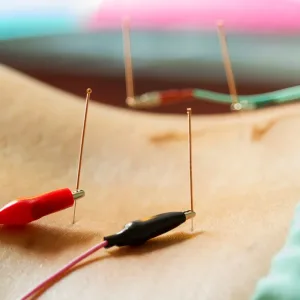 electro acupuncture treatment